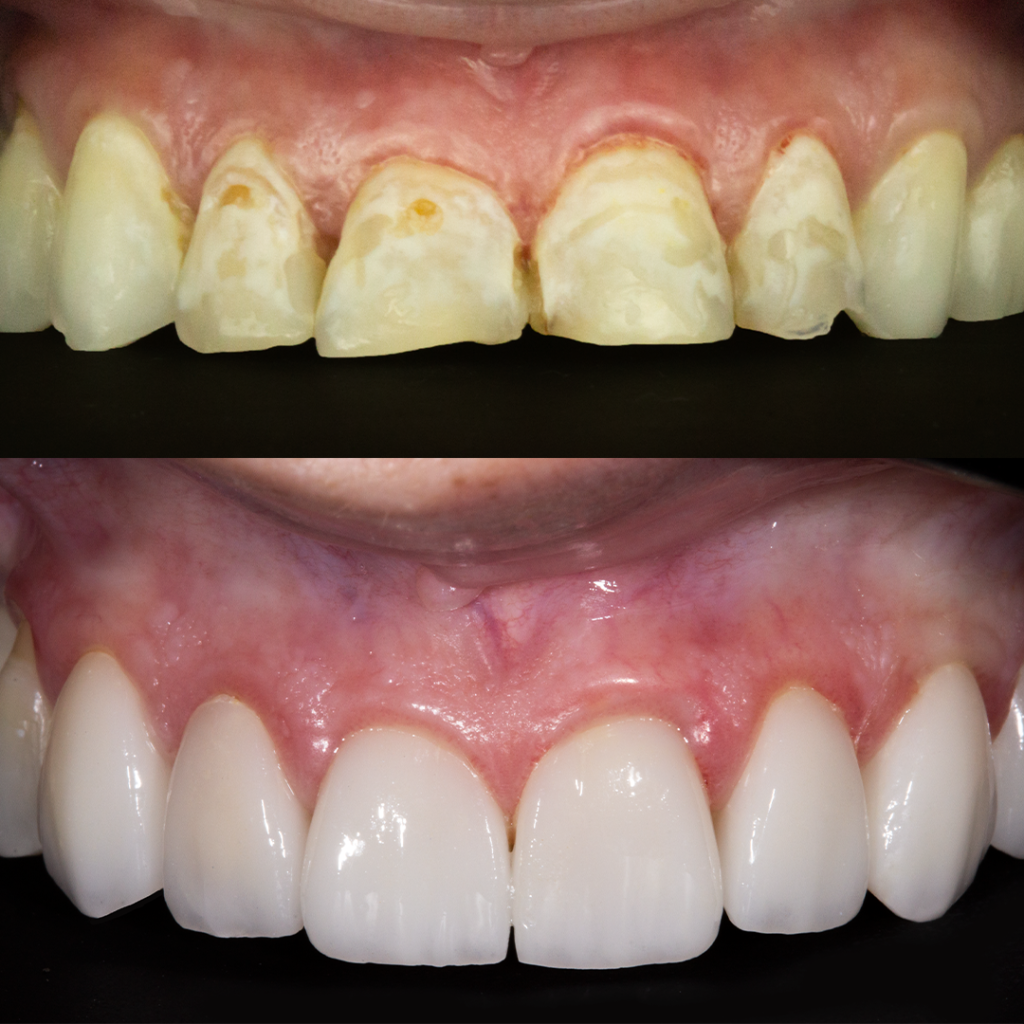 Antes e Depois - Lente de Contato Dental