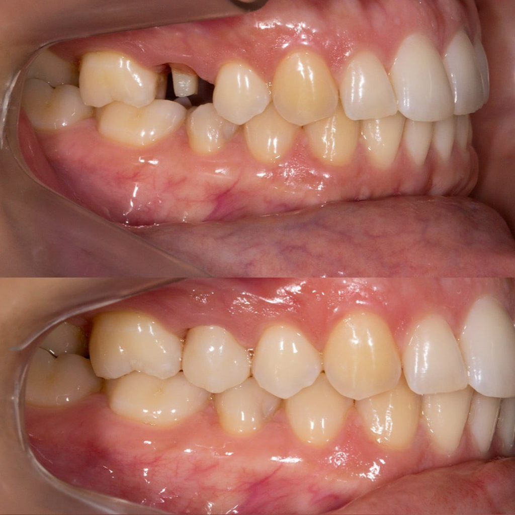 Antes e Depois - Prótese Sobre Dente