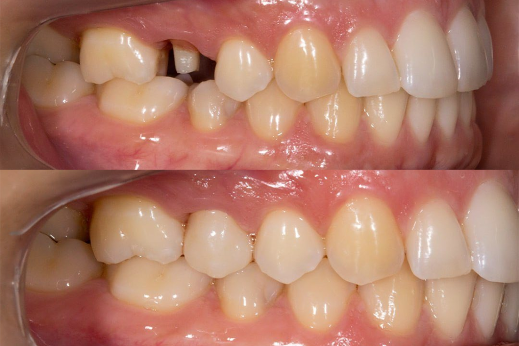 Próteses sobre Dente – Caso Clínico